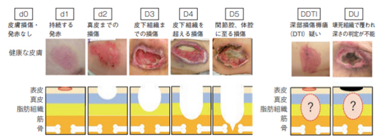 ステージ3の黒色腫の生存率はどれくらいですか?